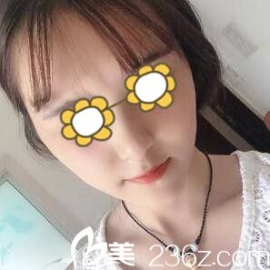 在韓國首爾整形外科做下頜角術(shù)后半個月效果