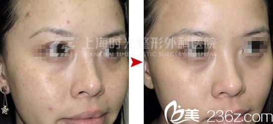 上海時光整形外科醫(yī)院左雯君蜂巢皮秒祛斑祛痘真人案例 上海時光整形外科醫(yī)院左雯君蜂巢皮秒祛斑祛痘真人案例