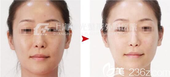 上海時光整形外科醫(yī)院左雯君 美白祛黃真人案例 上海時光整形外科醫(yī)院左雯君 美白祛黃真人案例