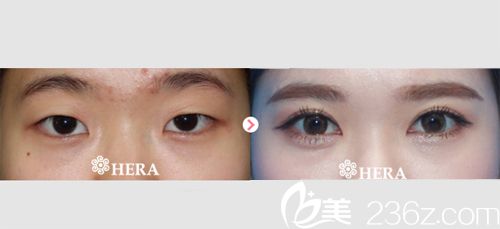 韓國赫拉(HERA)整形醫(yī)院雙眼皮案例對比圖 韓國赫拉(HERA)整形醫(yī)院雙眼皮案例對比圖