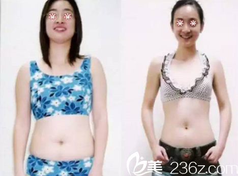 鄭鎬勛院長腰腹部吸脂案例