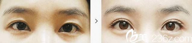 金鴻烈院長雙眼皮消失修復(fù)案例