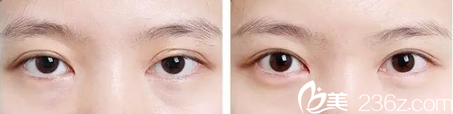 金鴻烈院長雙眼皮不對稱修復(fù)案例