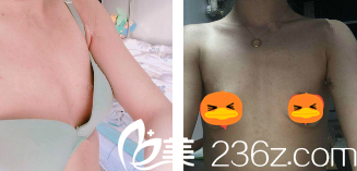 術(shù)前胸部干癟 術(shù)前胸部干癟