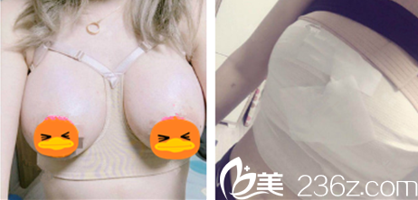 假體隆胸手術(shù)后胸部腫脹 假體隆胸手術(shù)后胸部腫脹