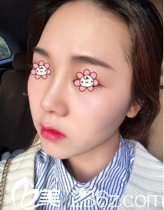 鄭鎬勛假體隆鼻術(shù)后11天