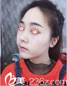 韓國I LOVE整形外科硅膠隆鼻術(shù)后18天