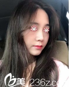 韓國I LOVE整形外科鄭鎬勛假體隆鼻術(shù)后一個(gè)月