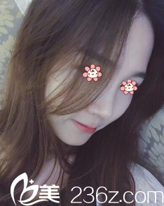 以下硅膠假體隆鼻+鼻綜合案例來自韓國I LOVE整形外科鄭鎬勛院長。