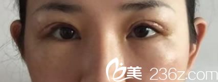 金華時(shí)光做雙眼皮修復(fù)7天效果 金華時(shí)光做雙眼皮修復(fù)7天效果