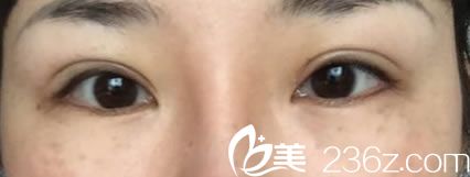 金華時(shí)光雙眼皮修復(fù)案例30天效果 金華時(shí)光雙眼皮修復(fù)案例30天效果