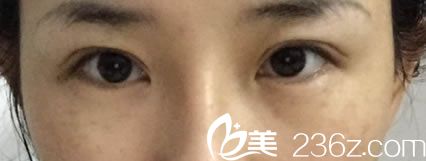 做完雙眼皮修復(fù)手術(shù)30天照片 做完雙眼皮修復(fù)手術(shù)30天照片
