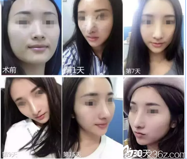 鼻綜合整形過程效果圖 鼻綜合整形過程效果圖