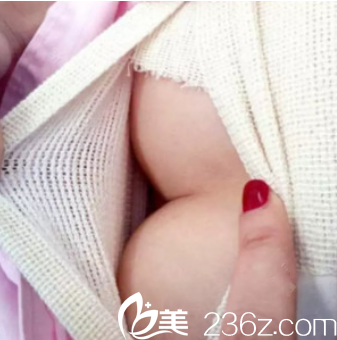 假體隆胸術(shù)后三天恢復(fù)效果 假體隆胸術(shù)后三天恢復(fù)效果