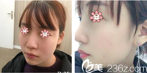 林秉州院長隆鼻修復(fù)案例 林秉州院長隆鼻修復(fù)案例