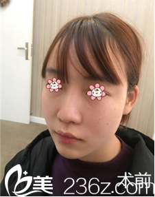 之前我做失敗的鼻子 之前我做失敗的鼻子