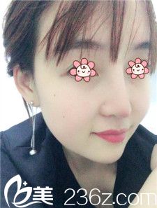 林秉州隆鼻失敗修復術(shù)后一周 林秉州隆鼻失敗修復術(shù)后一周