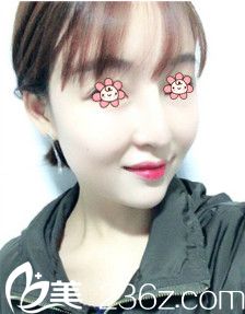 次假體隆鼻失敗了這回來(lái)韓國(guó)I WANT整形外科林秉州這兒做鼻綜合修復(fù)。