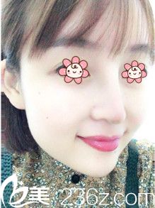 韓國I WANT整形外科鼻修復術(shù)后半個月 韓國I WANT整形外科鼻修復術(shù)后半個月