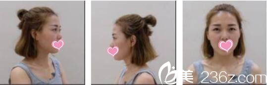 韓國Bone整形外科劉永俊切開法雙眼皮真人案例術(shù)前照 韓國Bone整形外科劉永俊切開法雙眼皮真人案例術(shù)前照