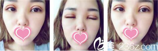 韓國Bone整形外科劉永俊切開法雙眼皮真人案例術(shù)后第三天 韓國Bone整形外科劉永俊切開法雙眼皮真人案例術(shù)后第三天