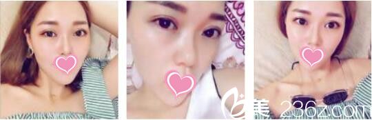 韓國Bone整形外科劉永俊切開法雙眼皮真人案例術(shù)后兩個月 韓國Bone整形外科劉永俊切開法雙眼皮真人案例術(shù)后兩個月