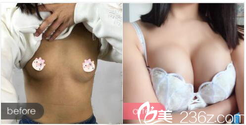 深圳富華曹孟君做的假體隆胸案例 深圳富華曹孟君做的假體隆胸案例