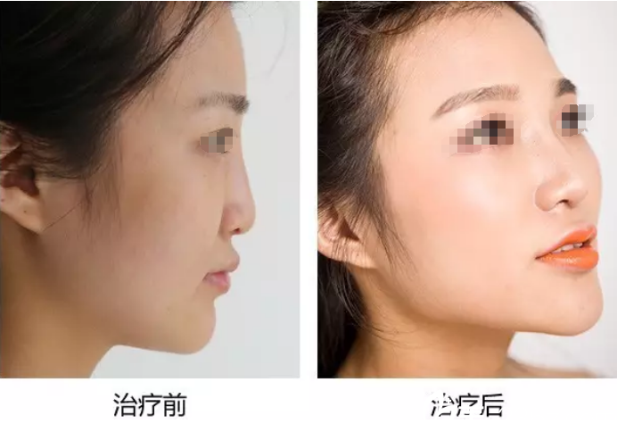 鼻子注射不明材料無法用玻尿酸溶解酶溶解 蘇州金閶李弼偉主任和聯(lián)合取出后做鼻綜合修復(fù)