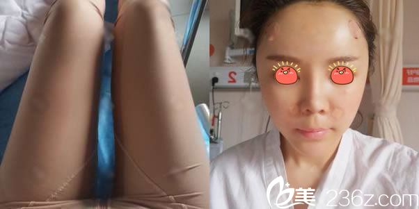 剛做完大腿抽脂和脂肪填充效果