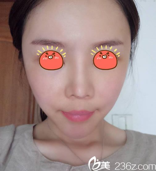 找李文鵬醫(yī)生做面填3天后