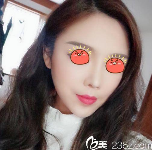 杭州連天美李文鵬脂肪填充30天后