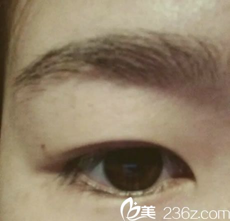 去寧波美仁整形做雙眼皮前 去寧波美仁整形做雙眼皮前