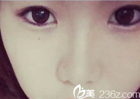 手術(shù)前貼雙眼皮貼后的眼睛 手術(shù)前貼雙眼皮貼后的眼睛