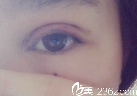 在寧波美仁整形做雙眼皮3天后 在寧波美仁整形做雙眼皮3天后