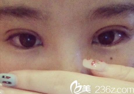 寧波美仁整形雙眼皮<span style= 寧波美仁整形雙眼皮<span style=