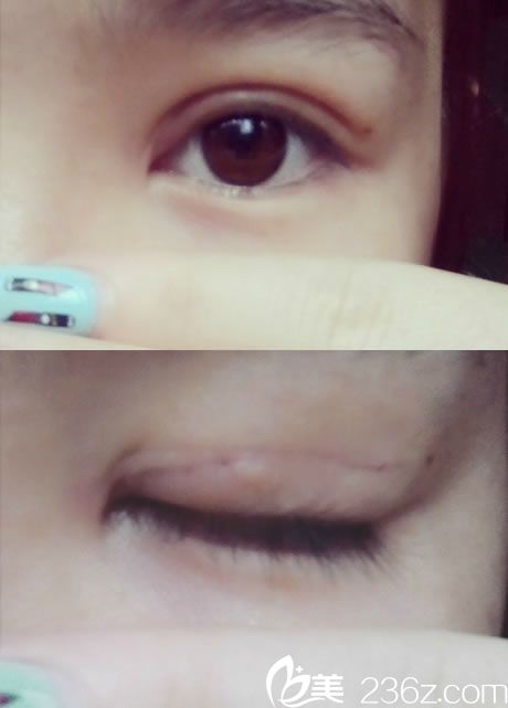 雙眼皮拆線當(dāng)天睜眼和閉眼圖片 雙眼皮拆線當(dāng)天睜眼和閉眼圖片