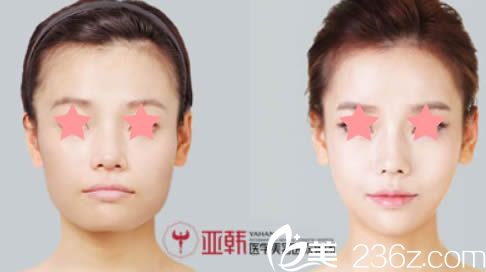 長沙亞韓整形醫(yī)院趙貴慶面部輪廓手術(shù)案例圖 長沙亞韓整形醫(yī)院趙貴慶面部輪廓手術(shù)案例圖