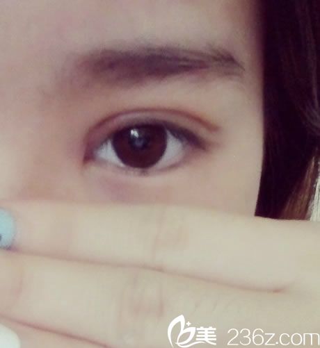 看我在寧波美仁整形美容做全切7mm平行雙眼皮+開(kāi)眼角恢復(fù)效果怎么樣