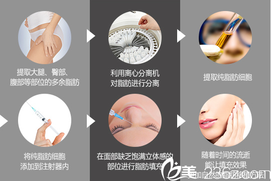 自體脂肪移植的過(guò)程