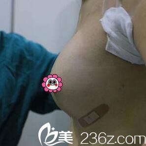 做假體隆胸術后即可效果 做假體隆胸術后即可效果