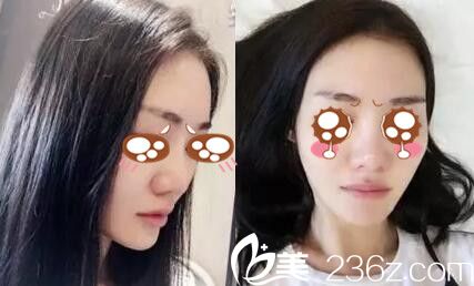 駐馬店金玄宮隆鼻顧客術(shù)前照 駐馬店金玄宮隆鼻顧客術(shù)前照