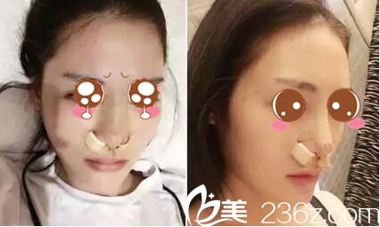 駐馬店金玄宮隆鼻手術(shù)即刻照 駐馬店金玄宮隆鼻手術(shù)即刻照