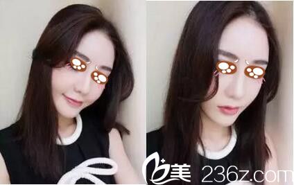 駐馬店金玄宮做隆鼻手術(shù)20天 駐馬店金玄宮做隆鼻手術(shù)20天