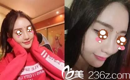 駐馬店金玄宮做隆鼻手術(shù)1個月 駐馬店金玄宮做隆鼻手術(shù)1個月