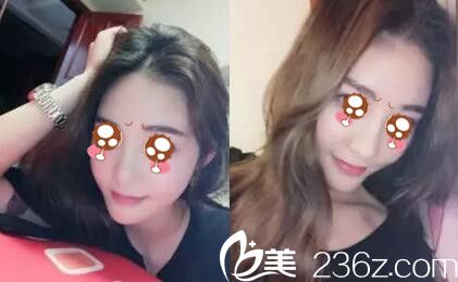 有幸在駐馬店金玄宮整形找張懷軍院長(zhǎng)做了假體隆鼻 3個(gè)月鼻子就恢復(fù)自然不懼揉捏