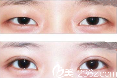 岳陽你美眼部整形效果