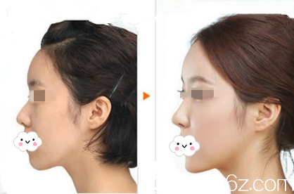 岳陽你美鼻部整形真人案例