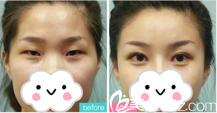 游鵬飛院長雙眼皮真人案例