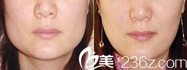 咬肌去除術(shù)對比案例