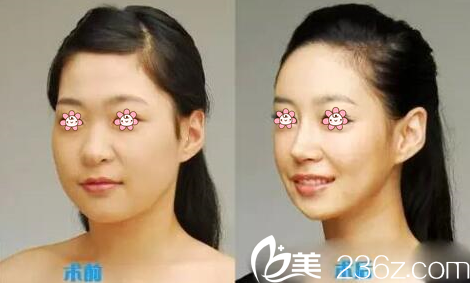 任在浩院長去頰脂墊案例 任在浩院長去頰脂墊案例